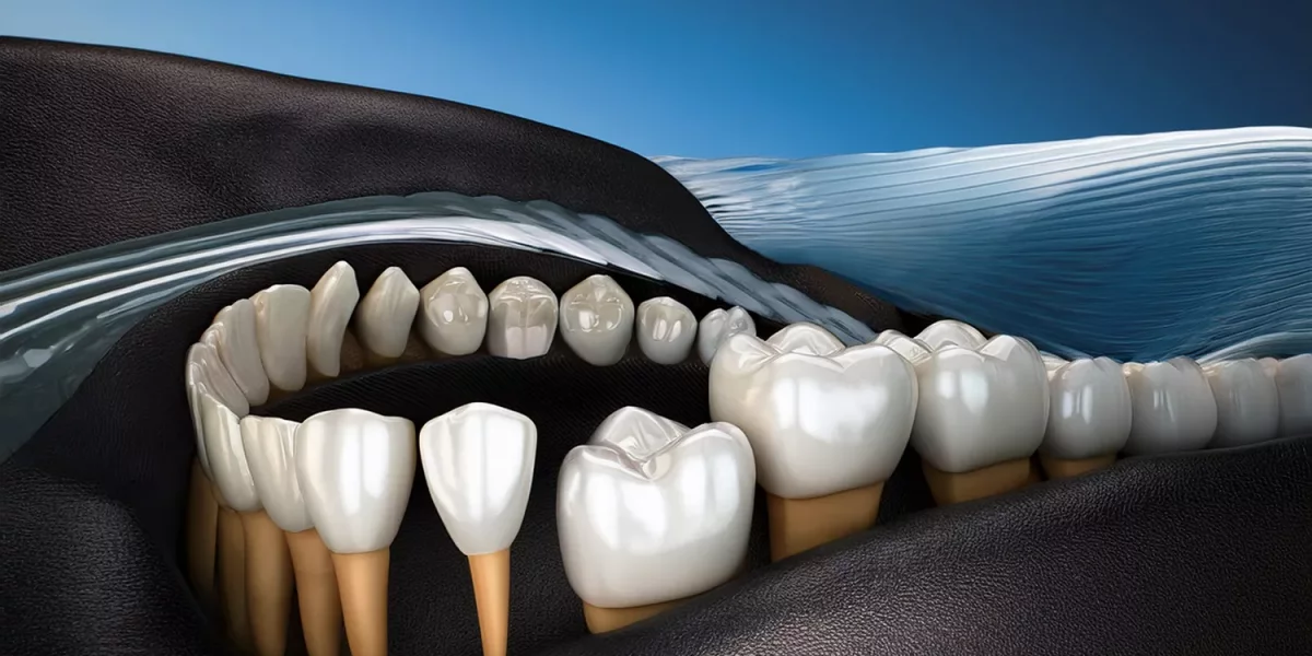 Büyük Dolgular ve Zirkonyum Restorasyonlar