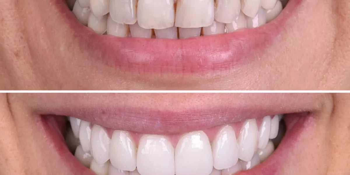 Neden Şimdi Bu Kadar Çok İnsan Hollywood Smile İstiyor?