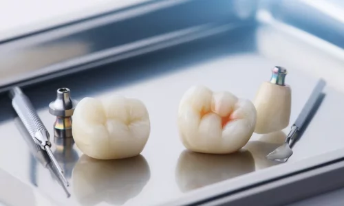 Malzemeler Açıklandı: Zirkonya vs Emax, Vidalı vs Simantasyonlu - Milim Dental Hospital