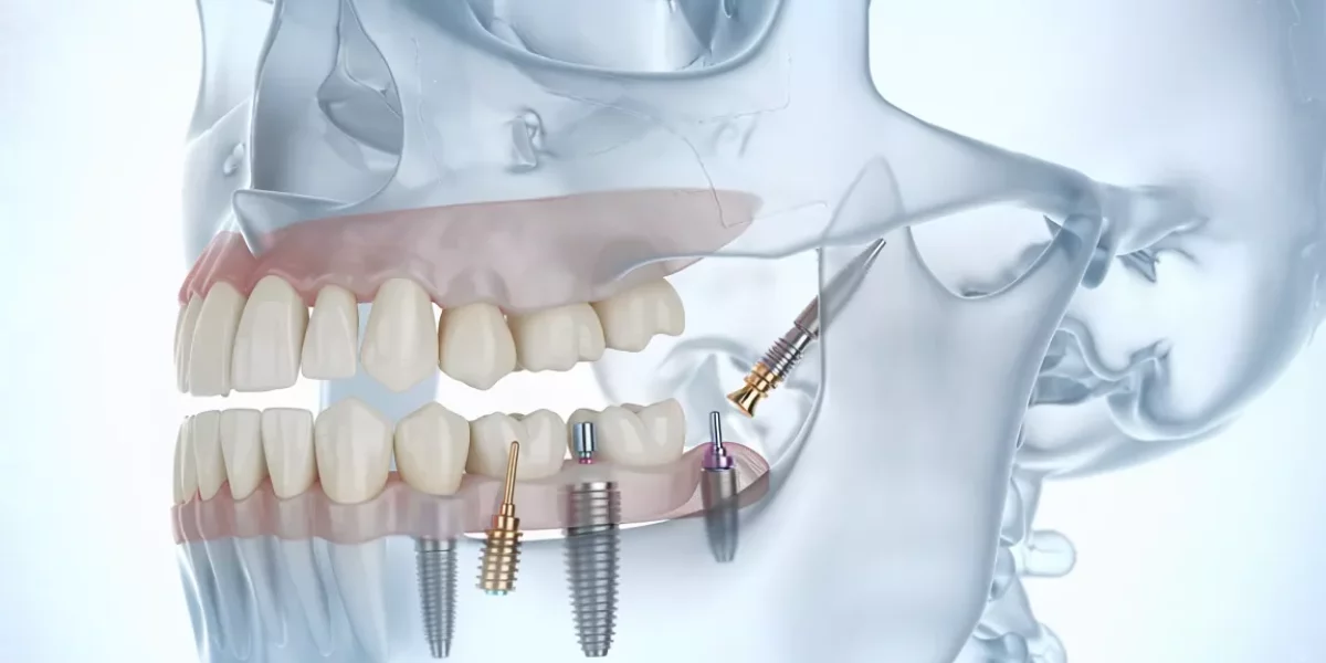 Şiddetli Üst Çene Kemik Kaybı için Zygomatic İmplantlar