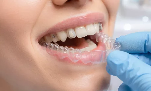 Invisalign'da Ataşmanlar (Düğmeler): Ne İşe Yararlar ve Neden Gerekli? - Milim Dental Hospital