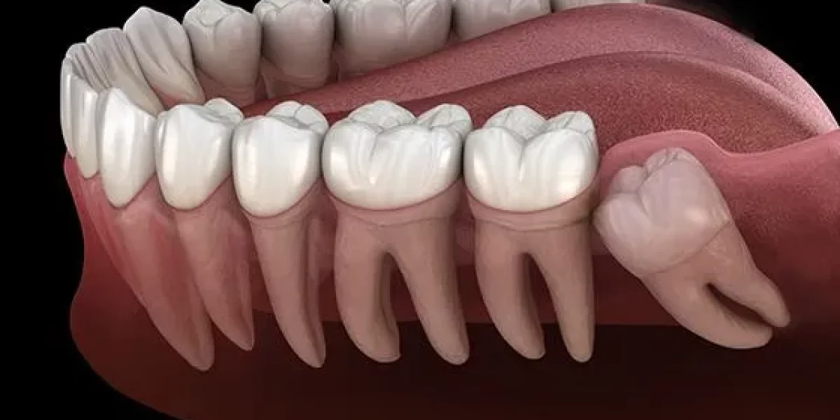 “20'lik Dişler (Akıl Dişi) Her Zaman Çekilmeli mi?” — Dürüst Cevap