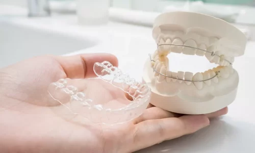Ortodonti Sonrası Retainerlar: Sabit ve Şeffaf Retainerlar ve Ne Kadar Süre Kullanılmalı? - Milim Dental Hospital
