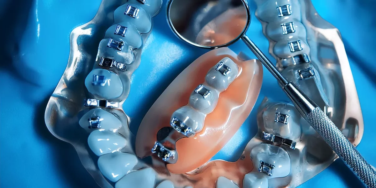 Hafif Diş Sıkışıklığı: Gerçekten Diş Çekimi Gerekli mi Yoksa Sadece Invisalign mı?