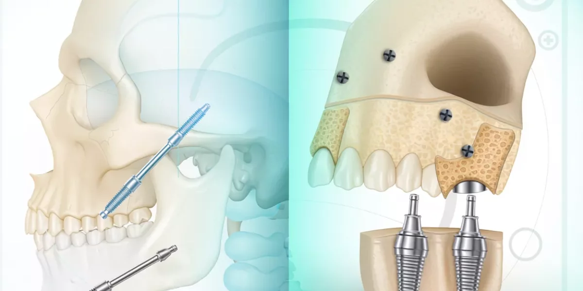 Zygomatic Implants vs Bone Grafting: Hangi Yöntem Daha Öngörülebilir?