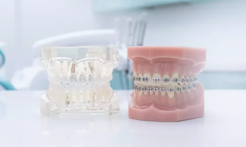 Can Invisalign fix crossbite or deep bite? - Milim Dental Hospital