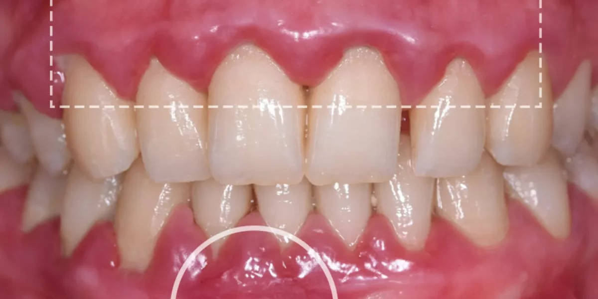 Diş Eti Hastalığı, Kanayan Diş Etleri ve Dişlerinizi Nasıl Kurtarırsınız