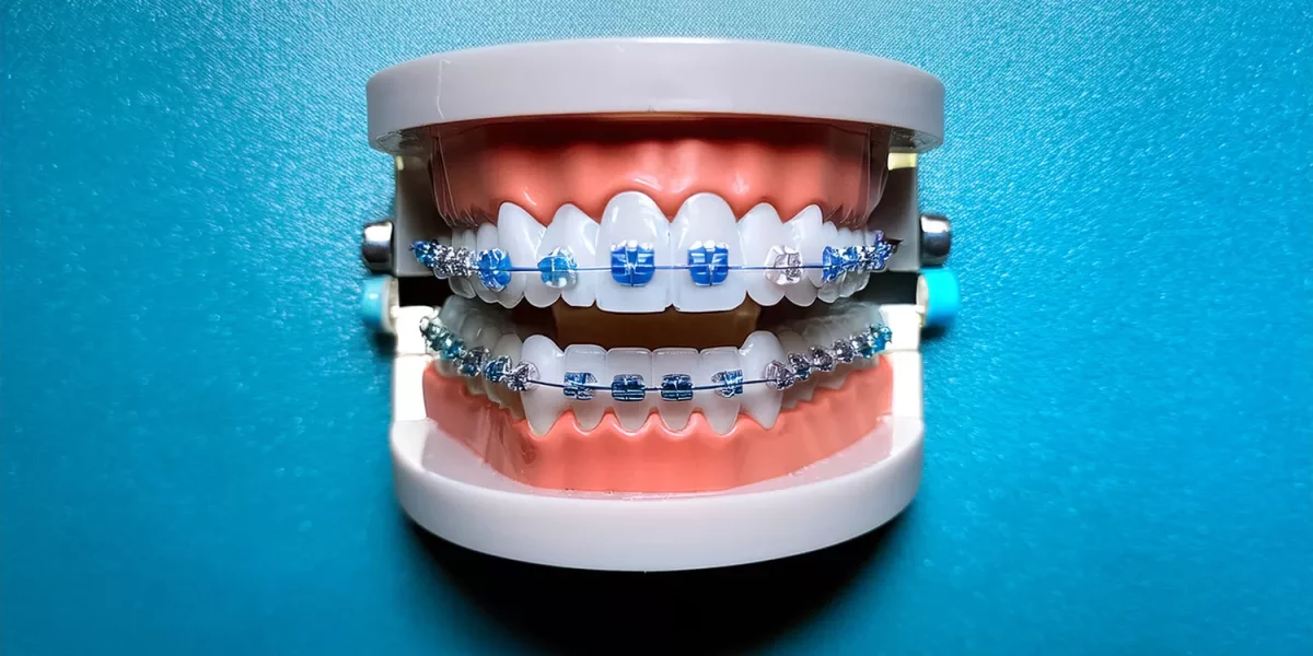 Gerçekten Braketlere İhtiyacım Var mı yoksa Invisalign Diş Sıkışıklığımı Düzeltebilir mi?