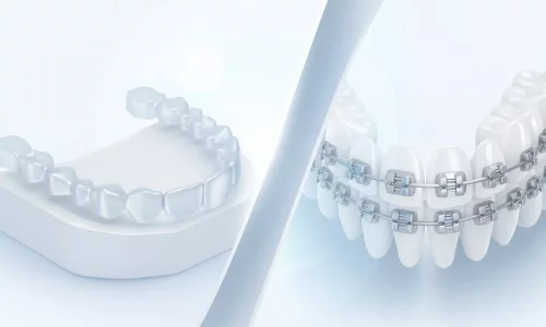 Hangi daha hızlı: şeffaf plaklar mı yoksa teller mi? - Milim Dental Hospital