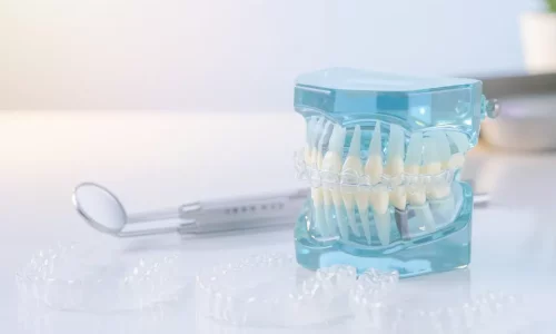 Orta dereceli çapraşıklık için şeffaf plaklar uygun mudur? - Milim Dental Hospital