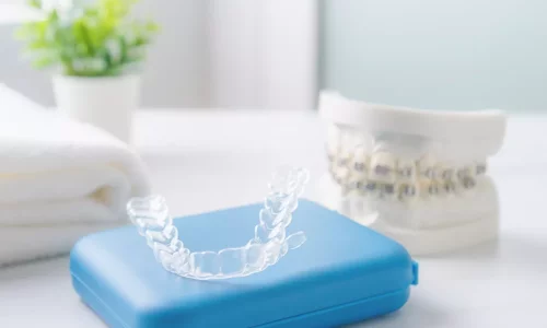 Seramik tellerden sonra hangi retainer kullanılır? - Milim Dental Hospital