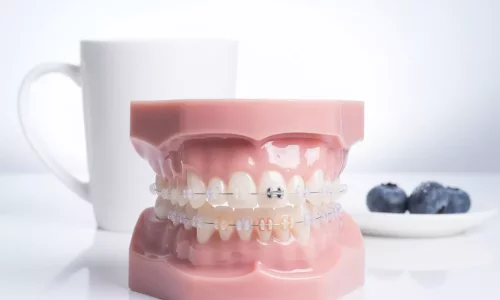 Seramik braketler leke yapar mı? - Milim Dental Hospital