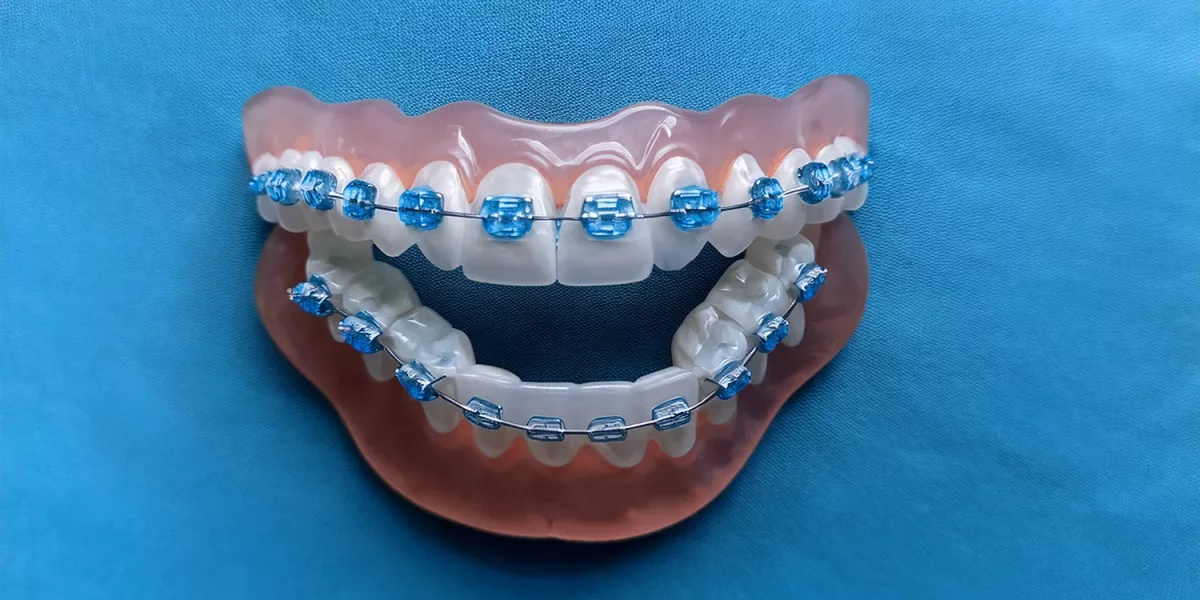 Invisalign Neden Lingual Braketlere Tercih Edilir?
