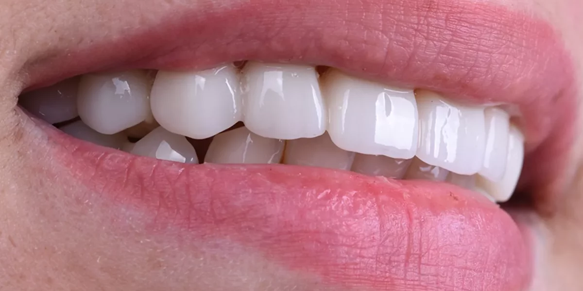 Türkiye’de Hollywood Smile: Bursa’daki Yabancıların Doğal Estetik Gülüş Tasarımı İçin MilimDental’i Seçme Nedenleri