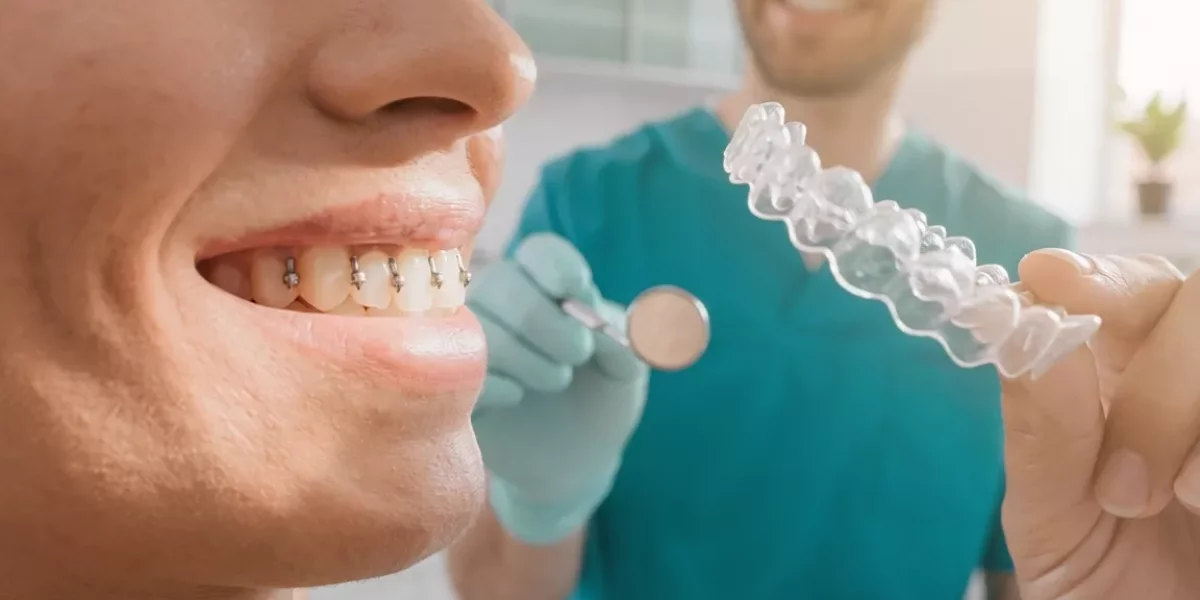Invisalign'da Ekler (Düğmeler): Ne İşe Yarar ve Neden Gerekli?