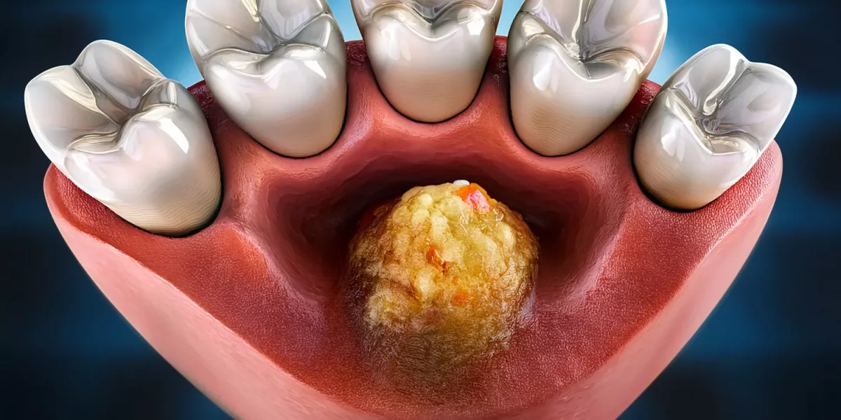 Kanal Tedavisinden Sonra Sürekli Apse: Kök Ucu Cerrahisi (Apikal Rezeksiyon) Nedir?