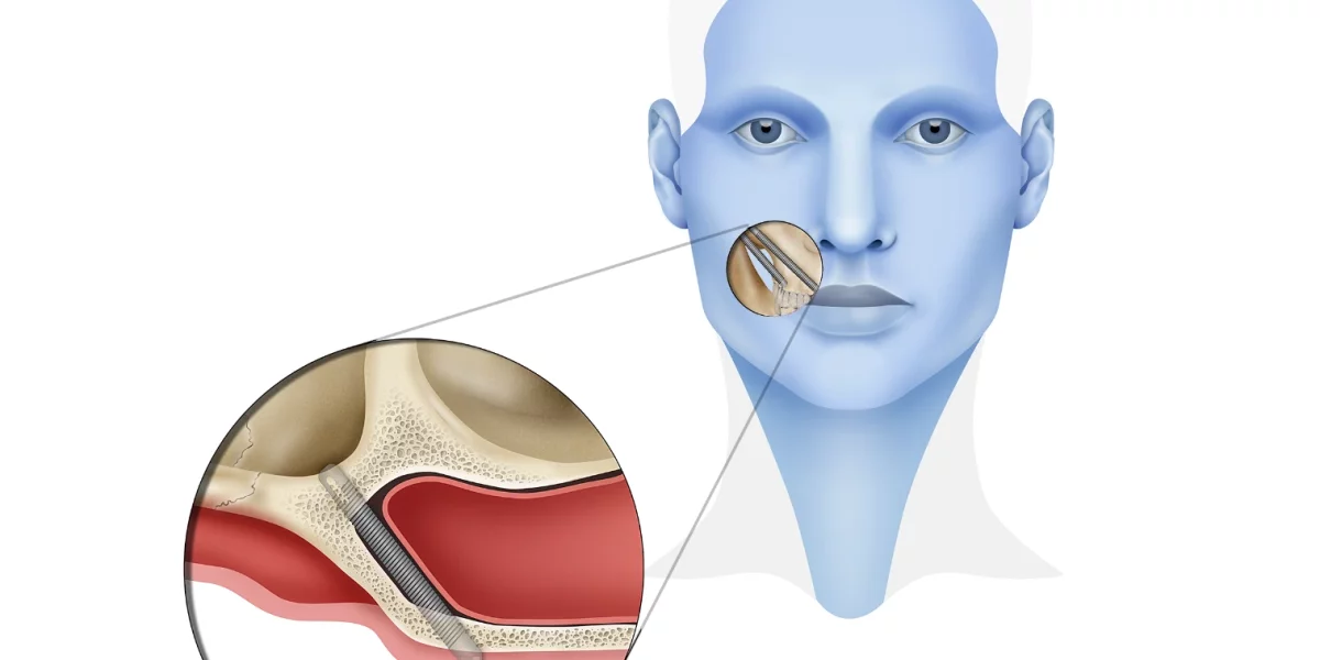 Kemik Kaybı Vakalarında Zygomatic İmplantların Faydaları