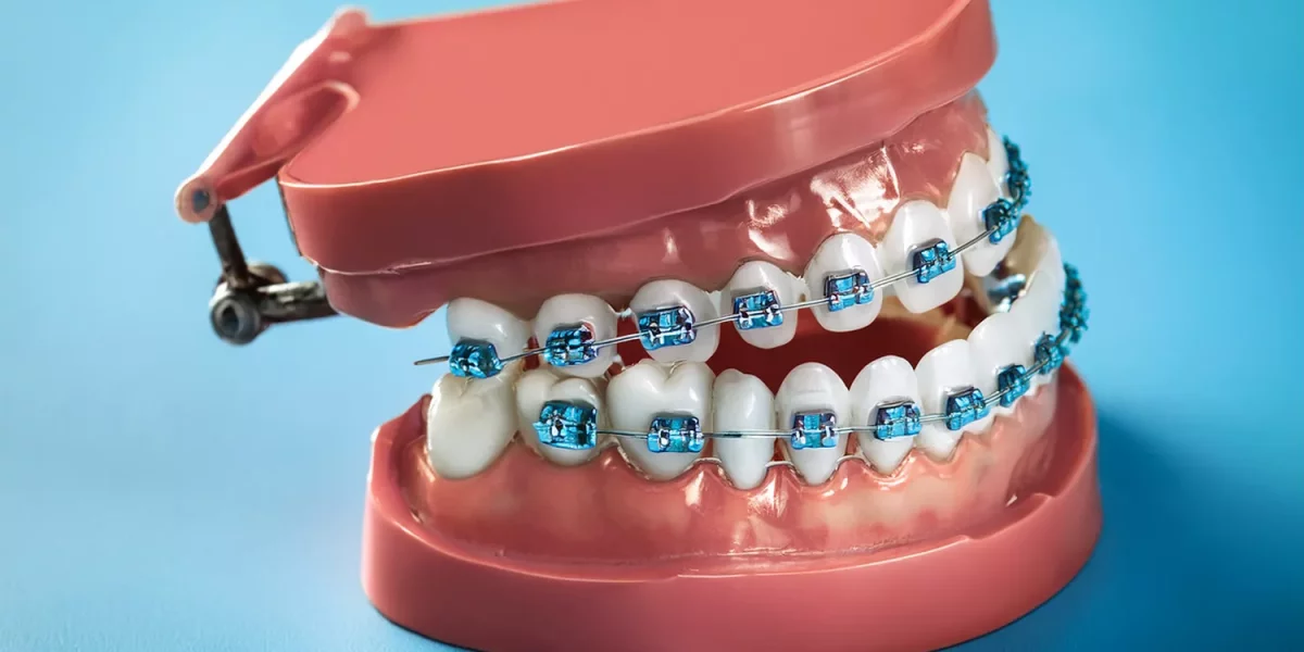 Ortodonti ve Diş İmplantları: Neden Sıra ve Zamanlama Önemlidir