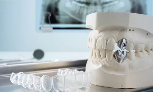 Hangi vakalar Invisalign için uygun değildir? - Milim Dental Hospital
