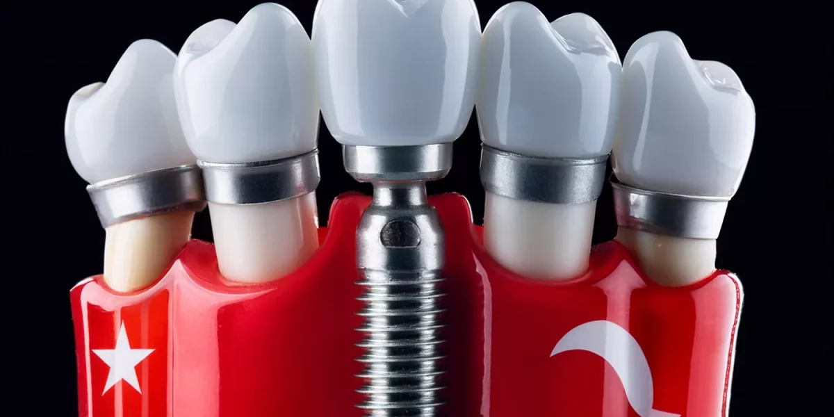 Türkiye’de Diş İmplantları: Tüm Süreç Gerçekten Ne Kadar Sürer?