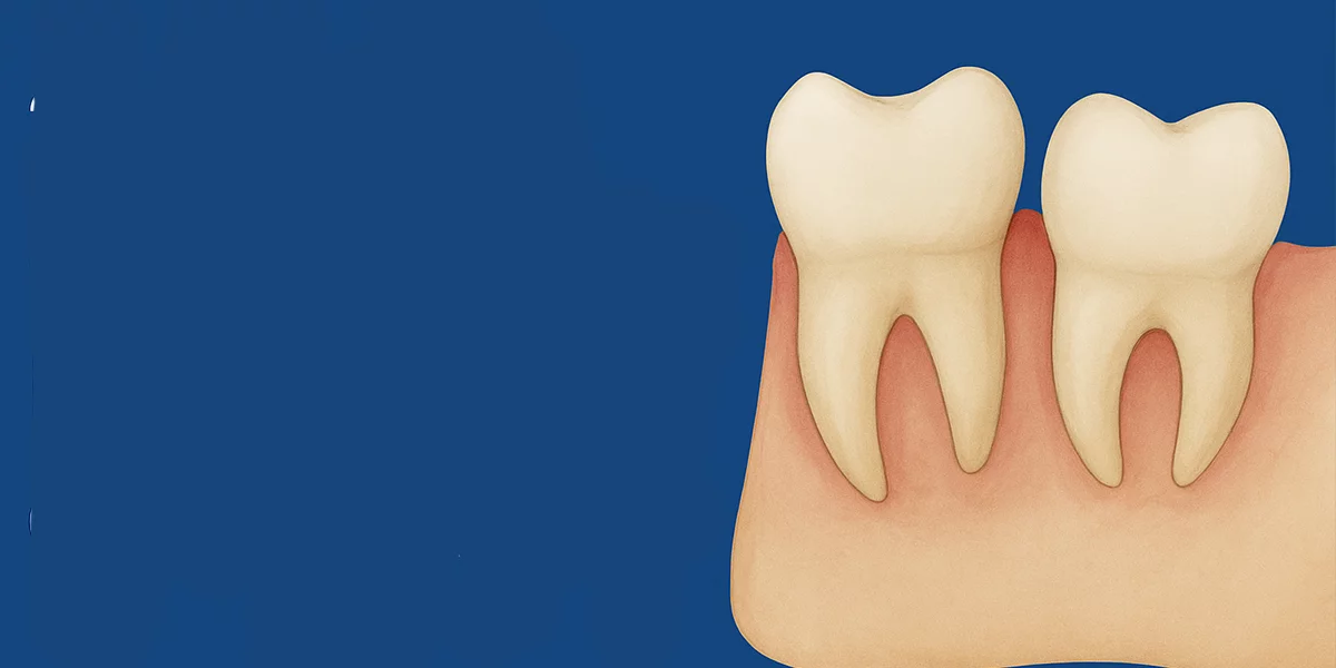 20'lik Diş (Akıl Dişi) çekimi Bursa: Her 20'lik diş çıkarılmalı mı?