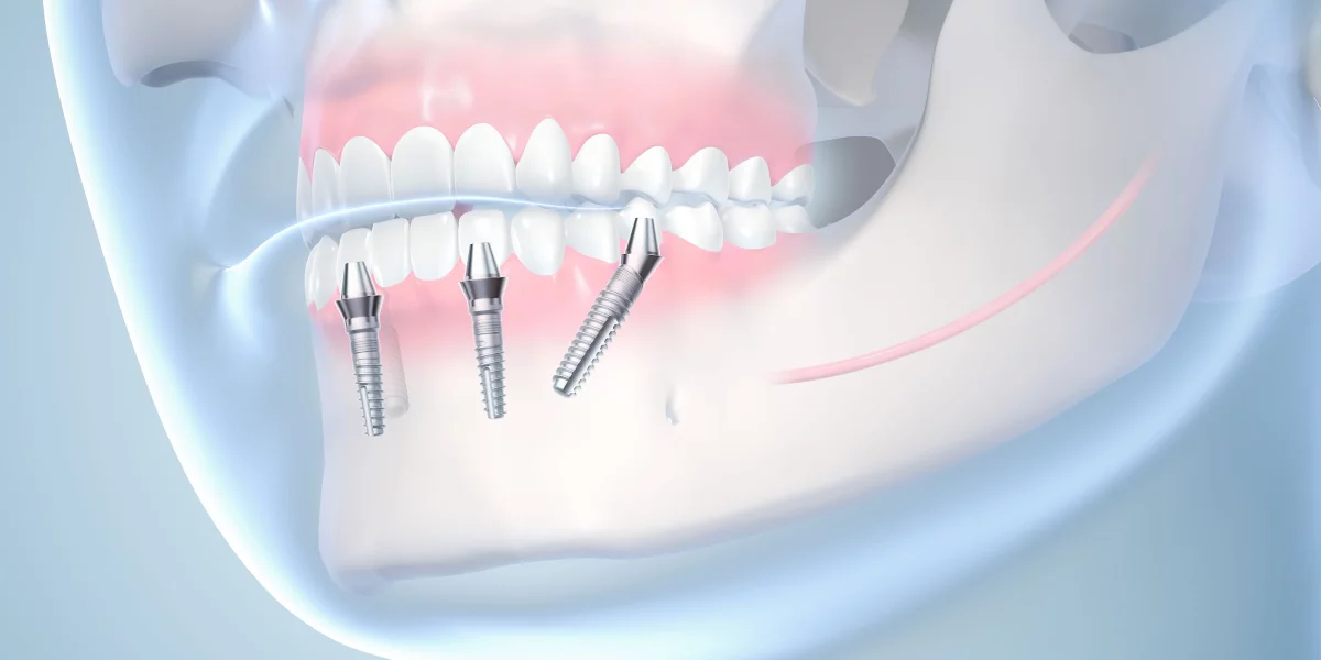 All-on-4 Sonrası İyileşme ve Toparlanma