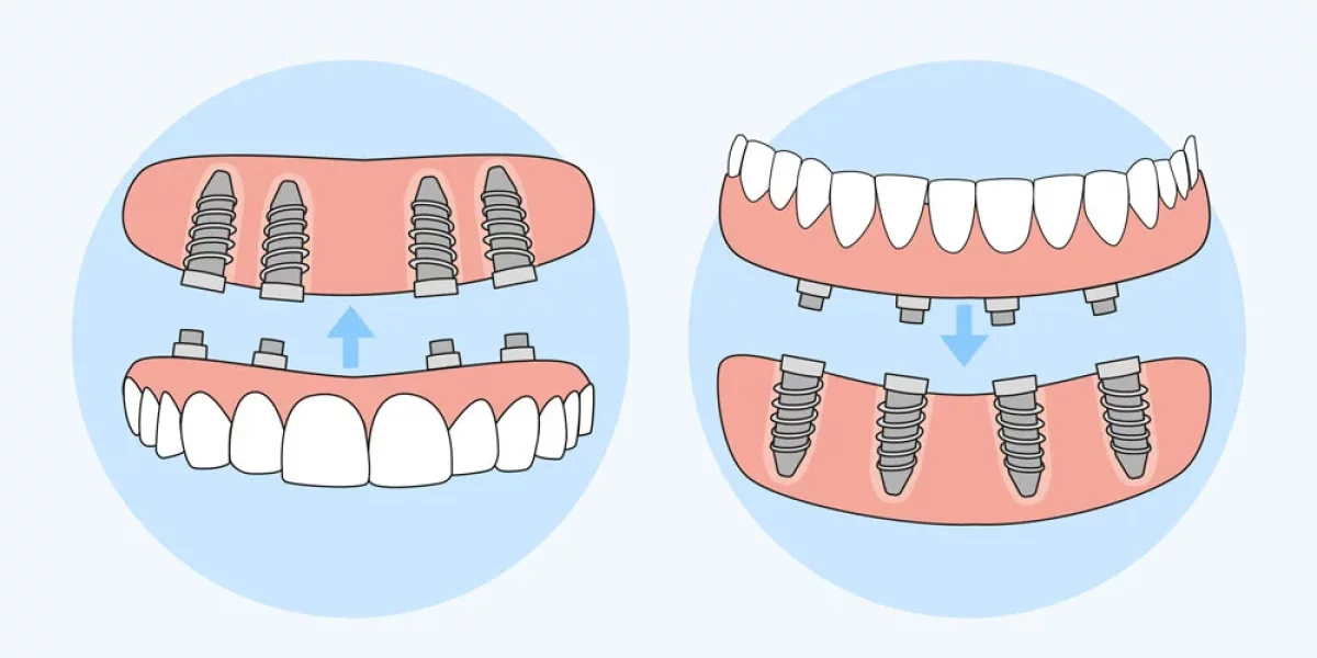 Bursa’da All-on-4 Diş İmplantlarıyla Gülüşünüzü Yenileyin – Milim Dental’den Hayat Değiştiren Çözüm