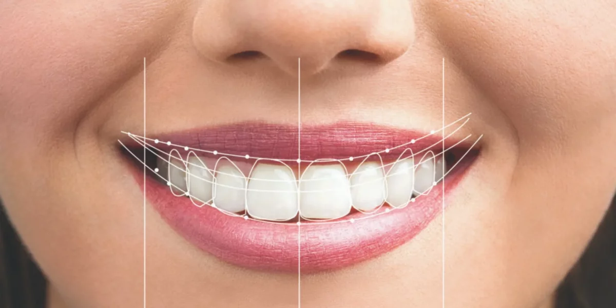 Hollywood Smile Yenileme Süreci: Neler Beklemelisiniz