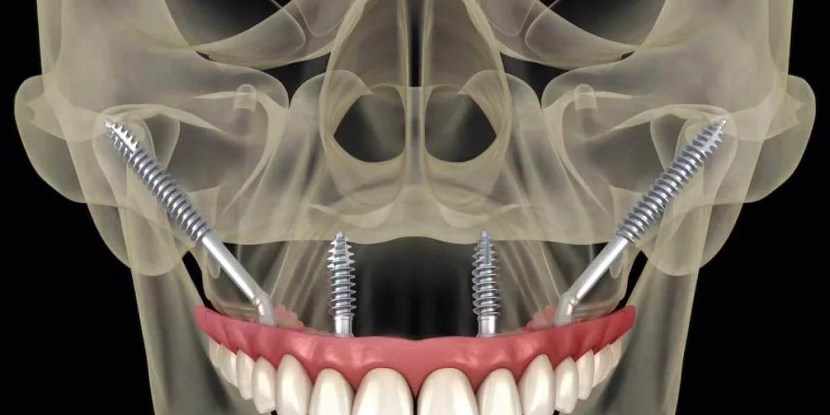 Zygomatik İmplantların Geleneksel İmplantlardan Farkı
