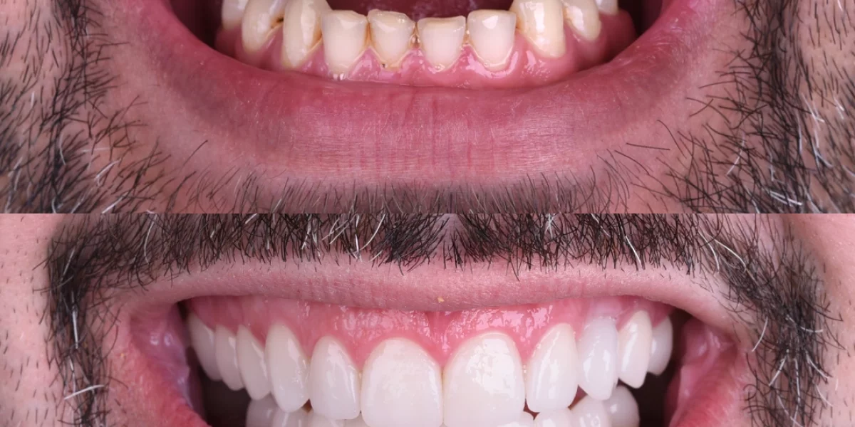 Hollywood Smile Nedir ve Görünümünüzü Nasıl Dönüştürebilir?