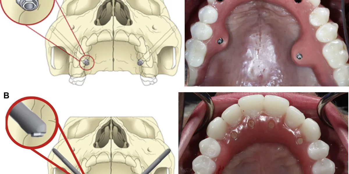 Zygomatic İmplantlar: Türkiye'de 