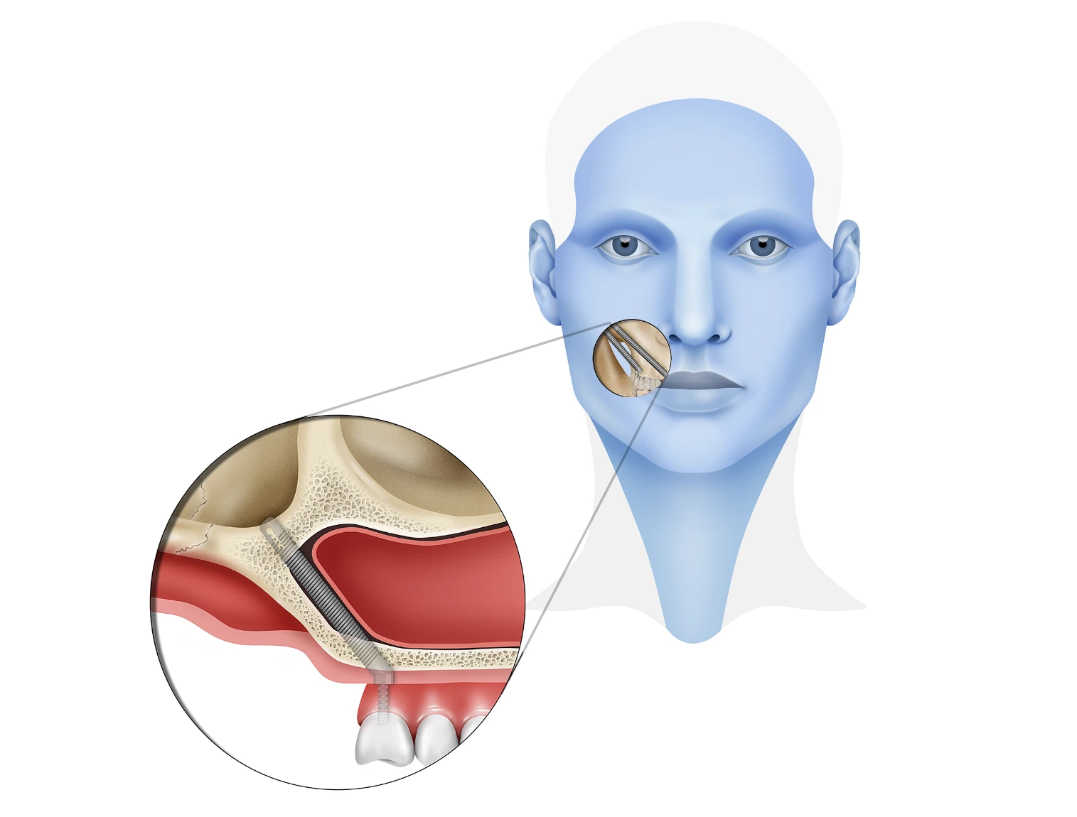 Kemik Kaybı Vakalarında Zygomatic İmplantların Faydaları