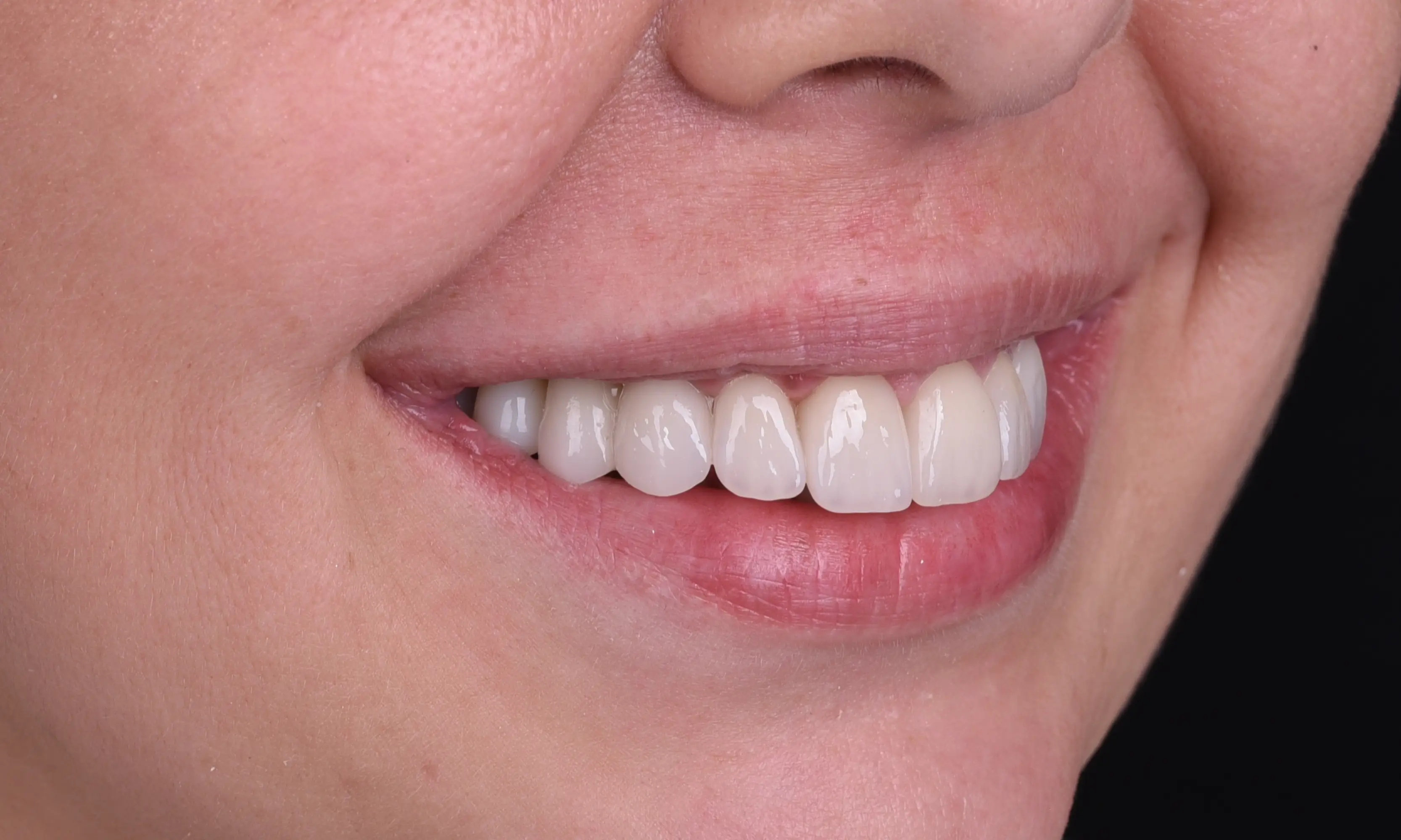 Full Veneers Sonrası - Vaka 15 - Milim Dental Hospital Bursa