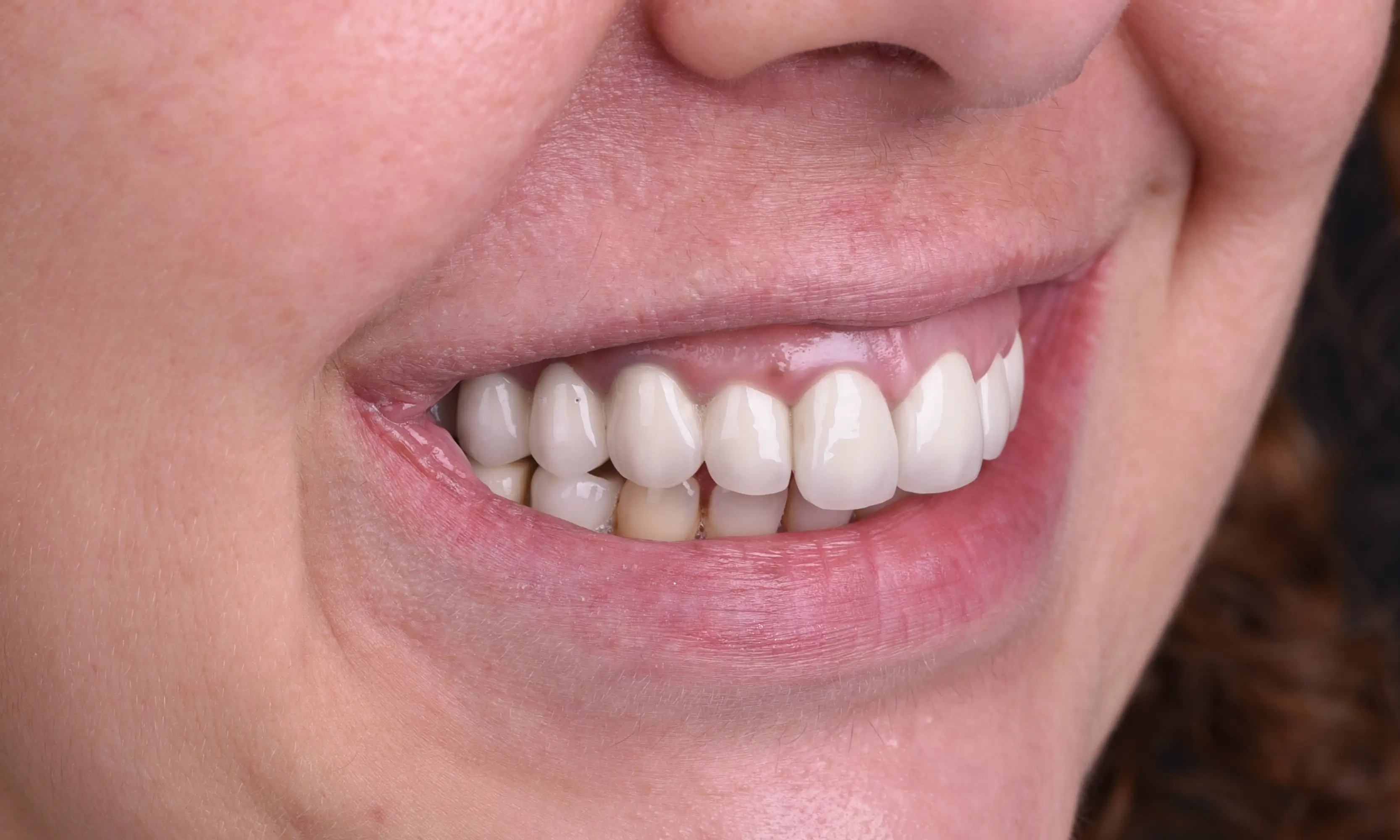 Full Veneers Öncesi - Vaka 15 - Milim Dental Hospital Bursa