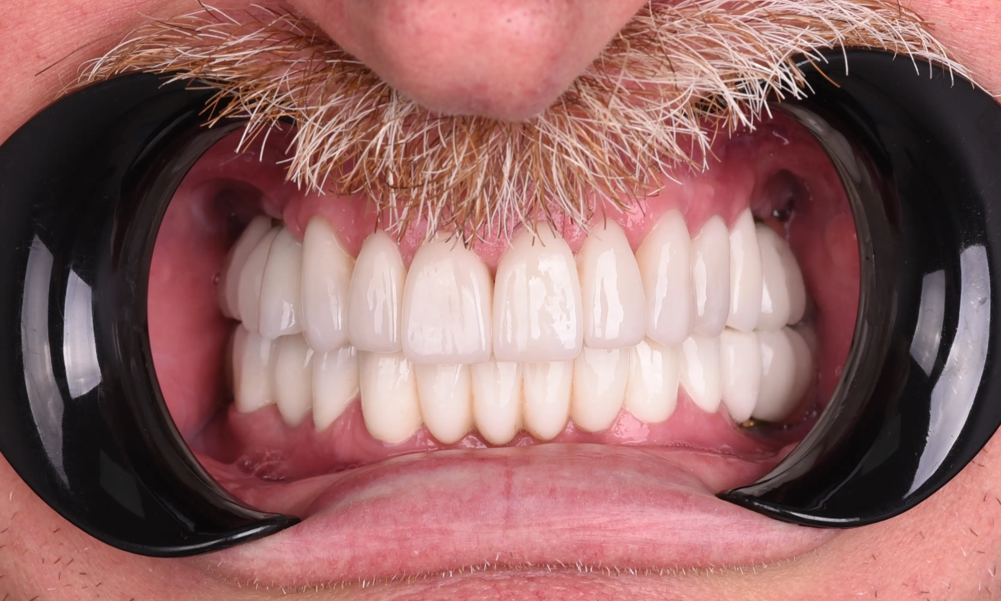 Full Veneers Sonrası - Vaka 16 - Milim Dental Hospital Bursa