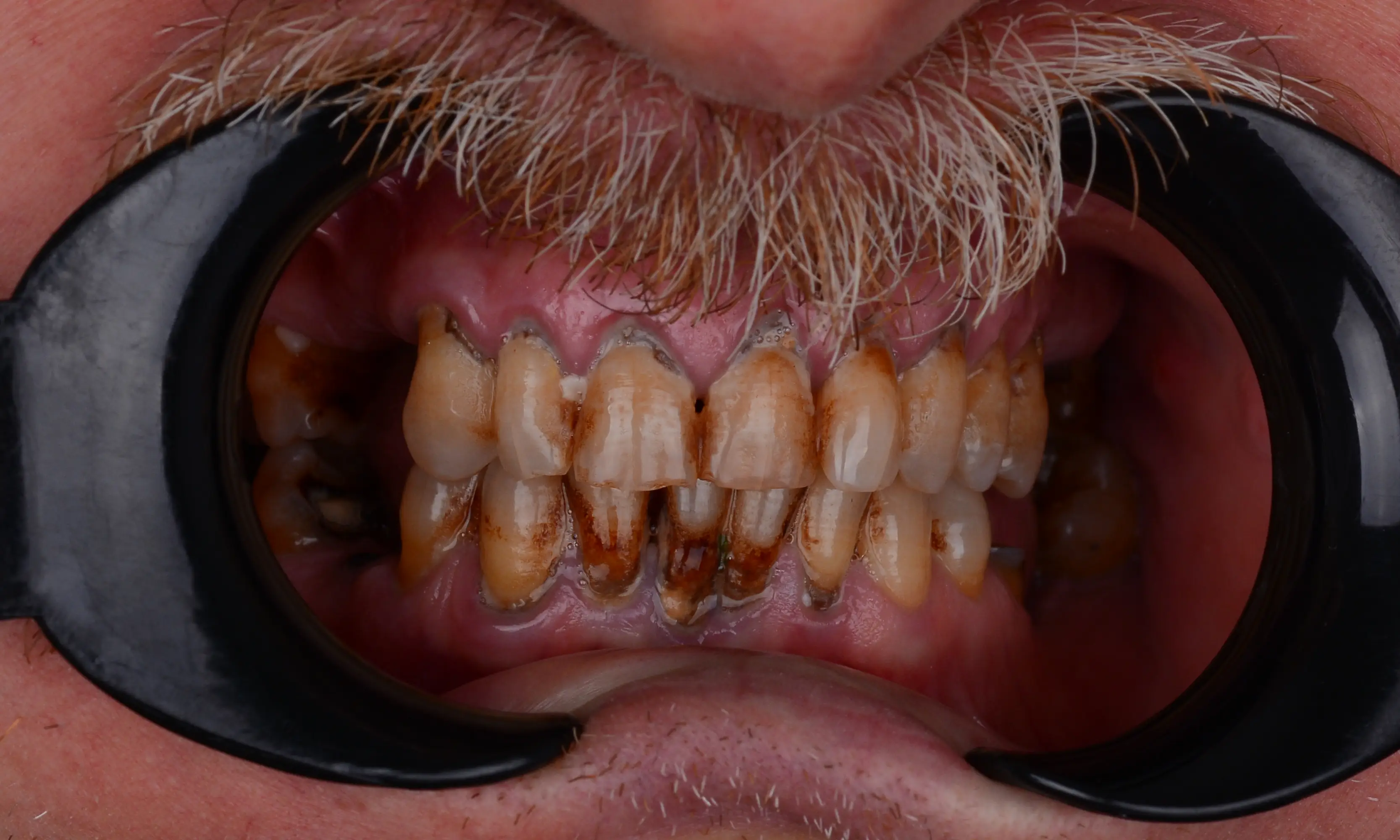 Full Veneers Öncesi - Vaka 16 - Milim Dental Hospital Bursa