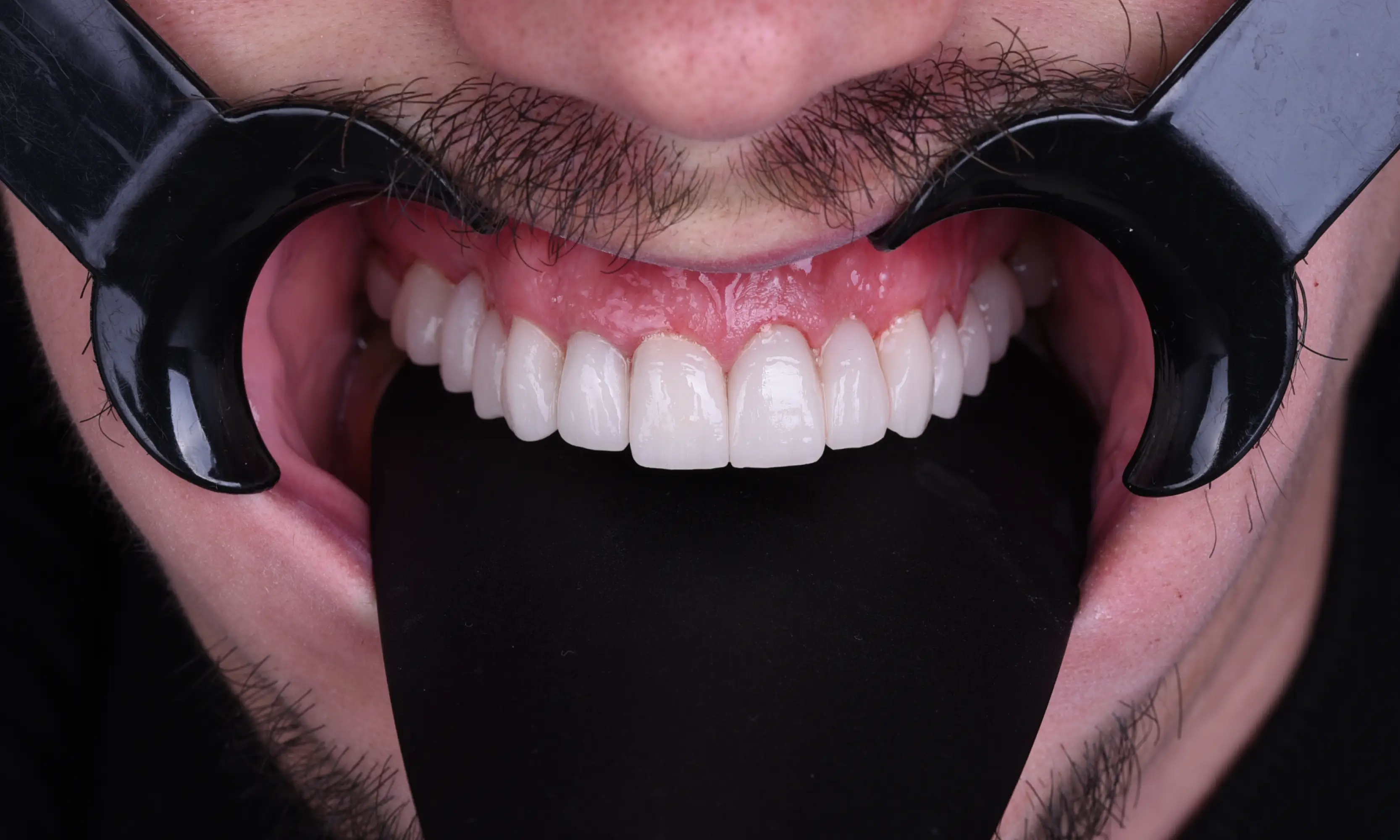 Full Veneers Sonrası - Vaka 17 - Milim Dental Hospital Bursa