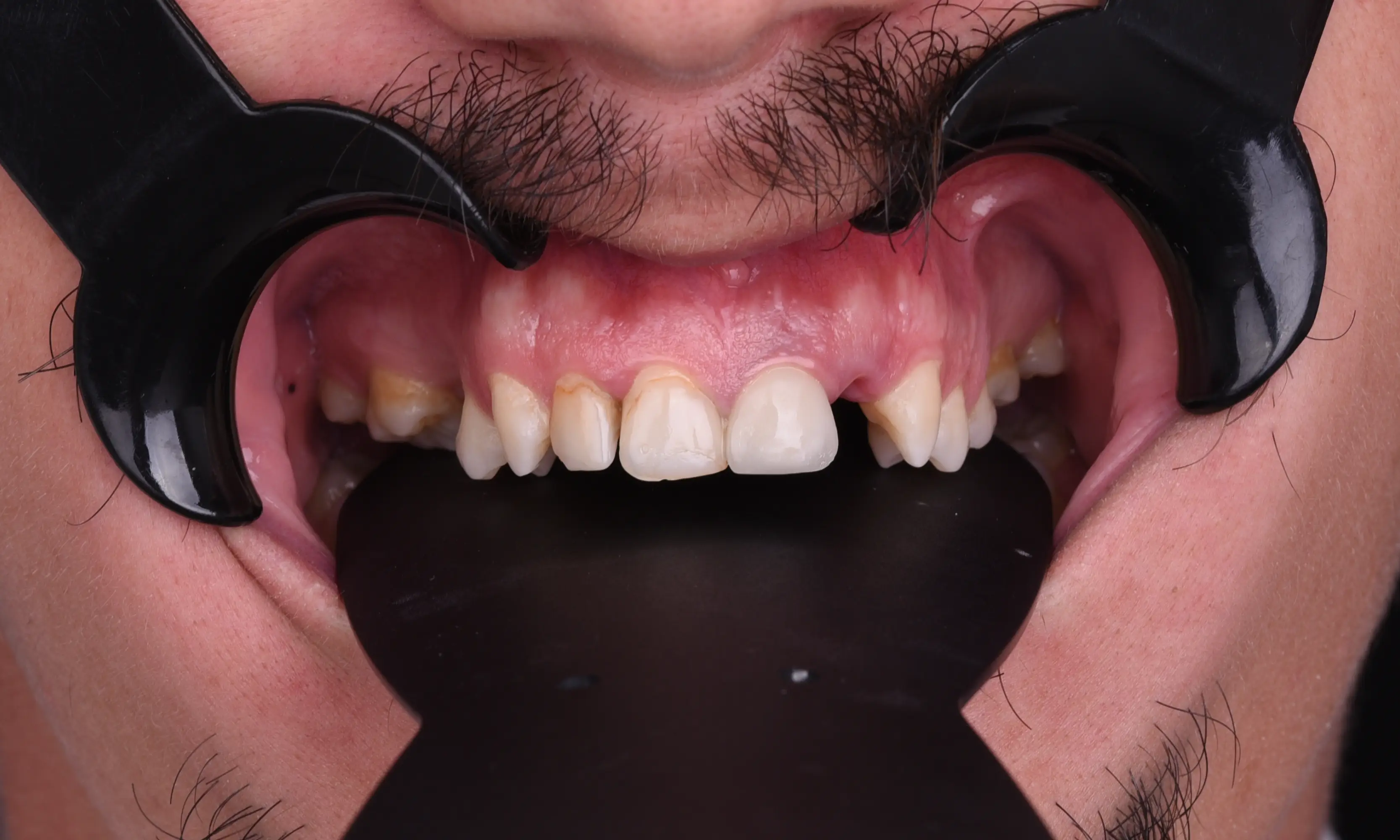Full Veneers Öncesi - Vaka 17 - Milim Dental Hospital Bursa