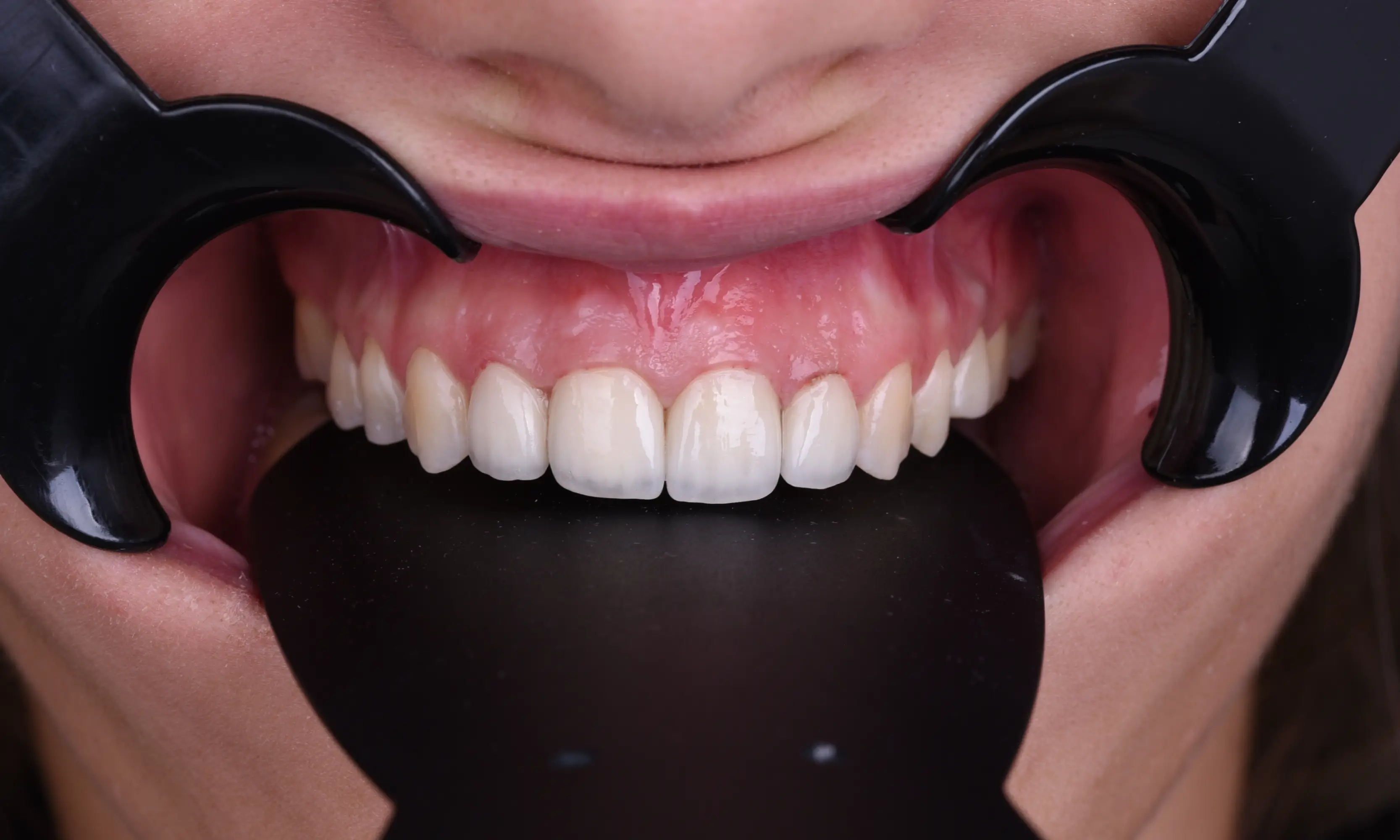 Full Veneers Sonrası - Vaka 18 - Milim Dental Hospital Bursa