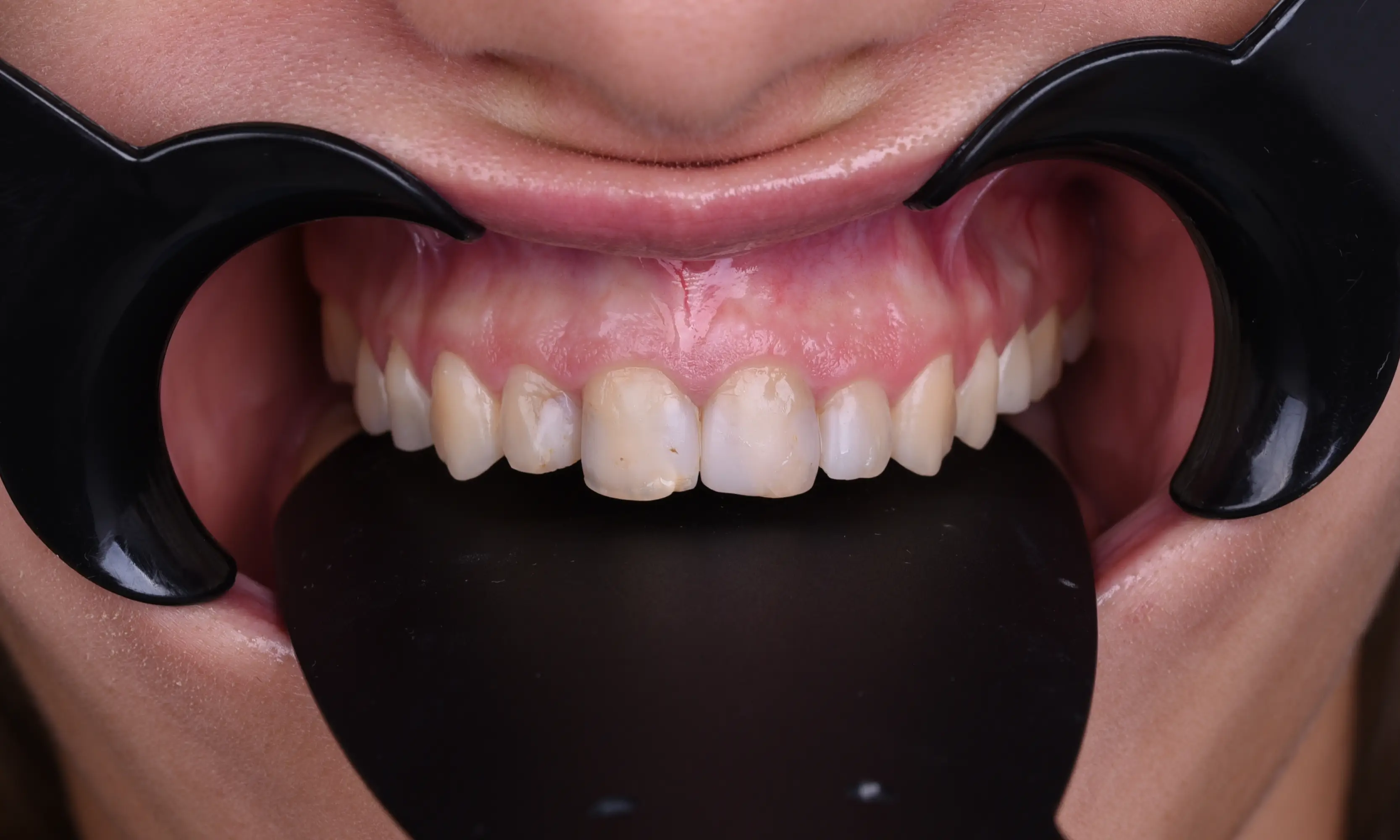 Full Veneers Öncesi - Vaka 18 - Milim Dental Hospital Bursa