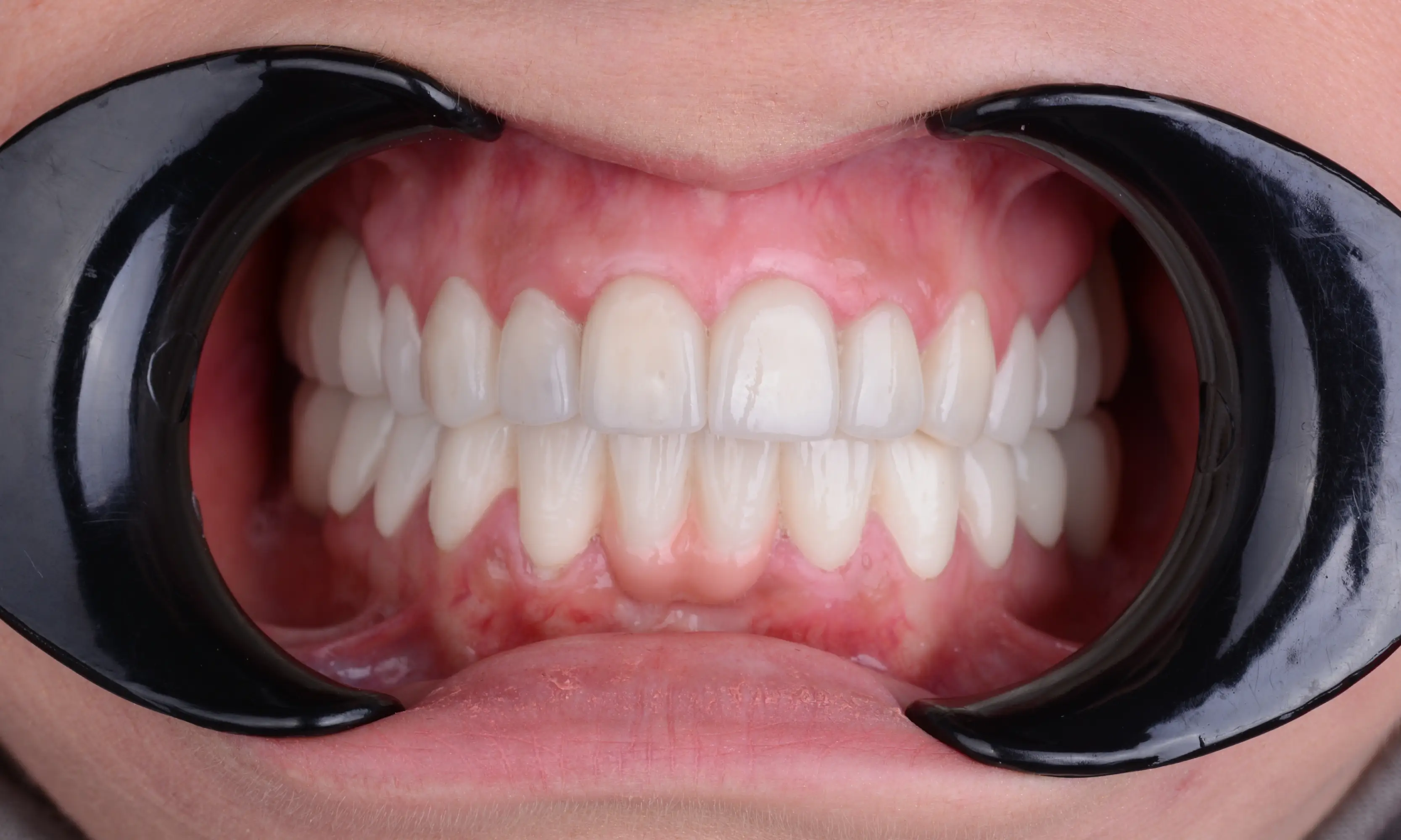 Full Veneers Sonrası - Vaka 25 - Milim Dental Hospital Bursa