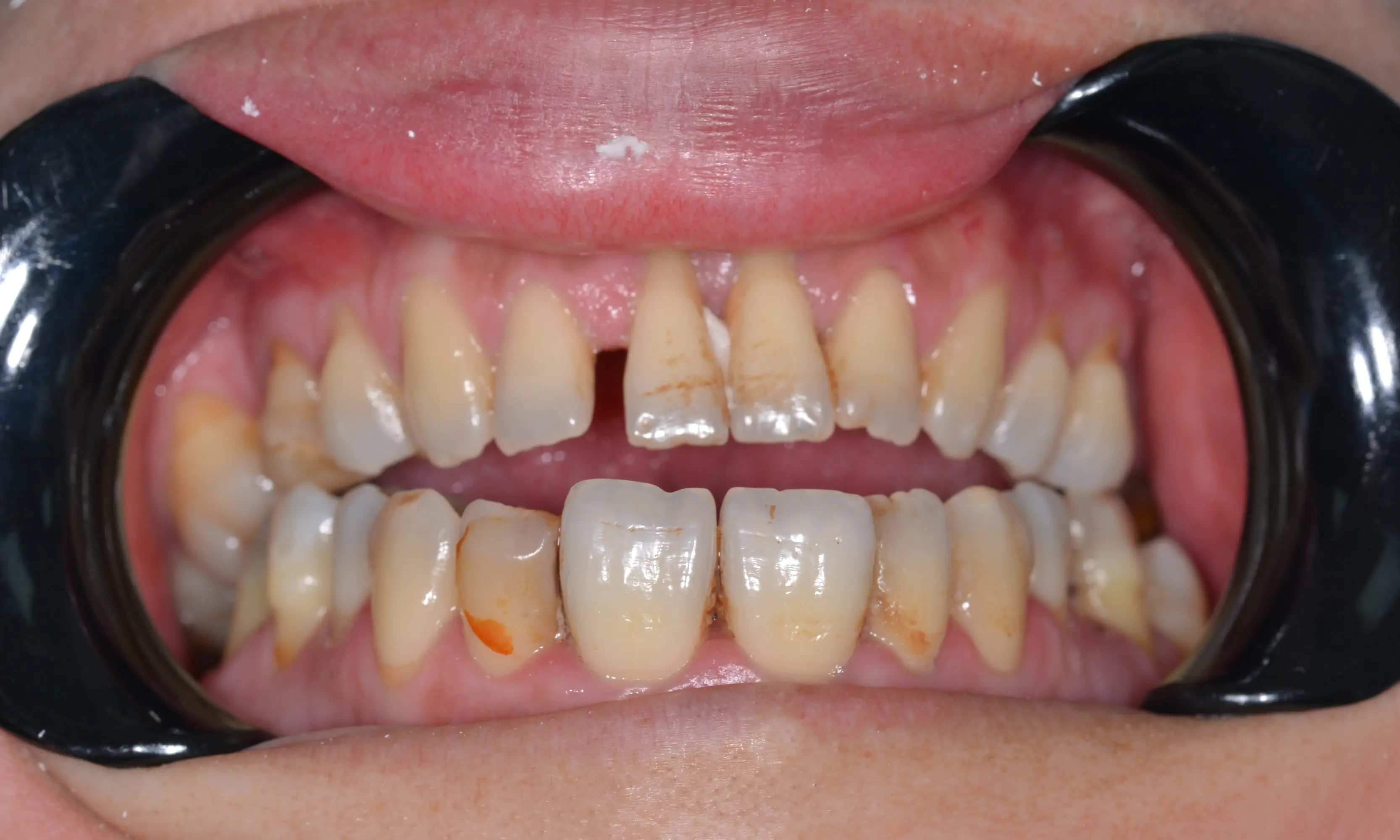 Full Veneers Öncesi - Vaka 25 - Milim Dental Hospital Bursa