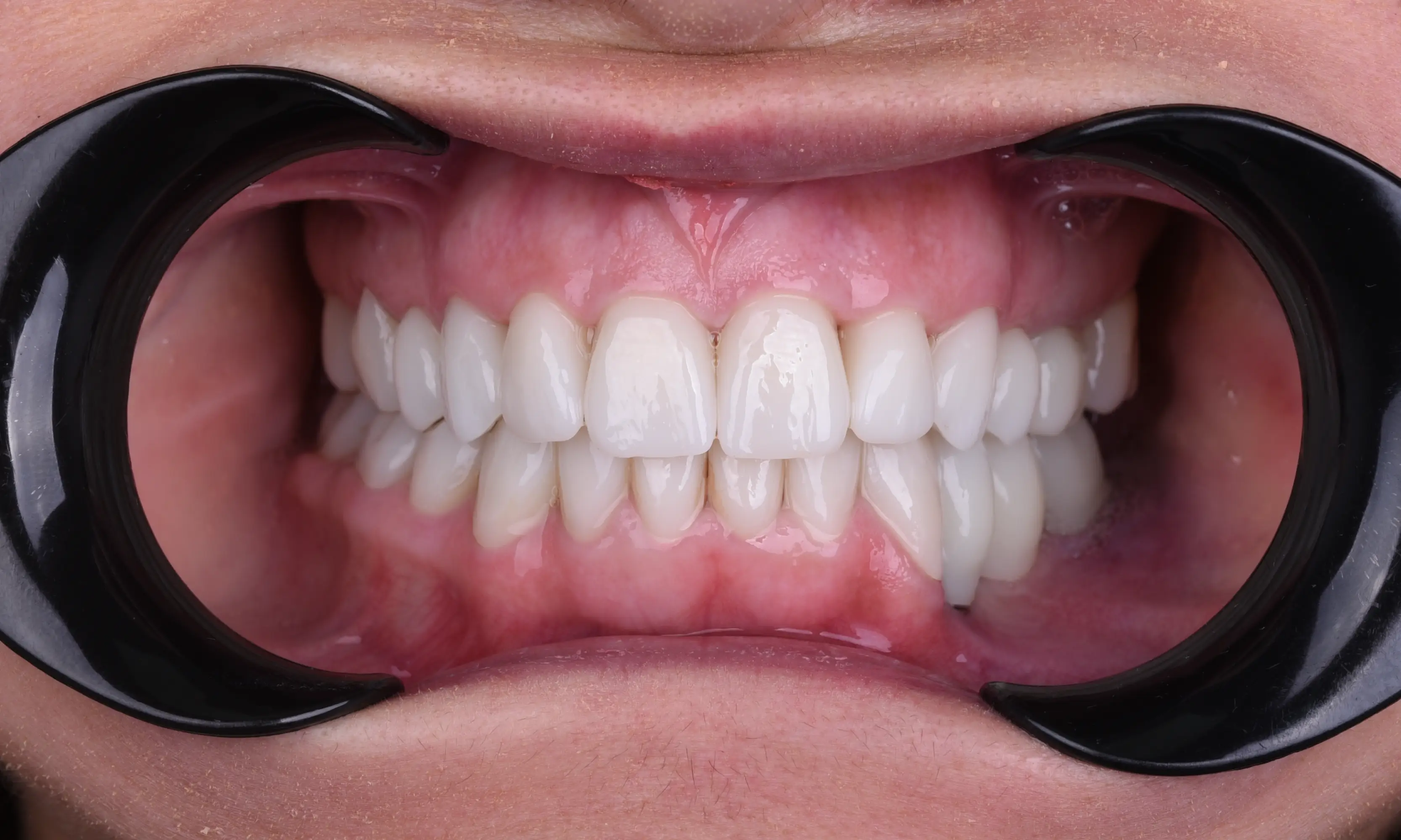 Tam Zirkonyum Sonrası - Vaka 26 - Milim Dental Hospital Bursa