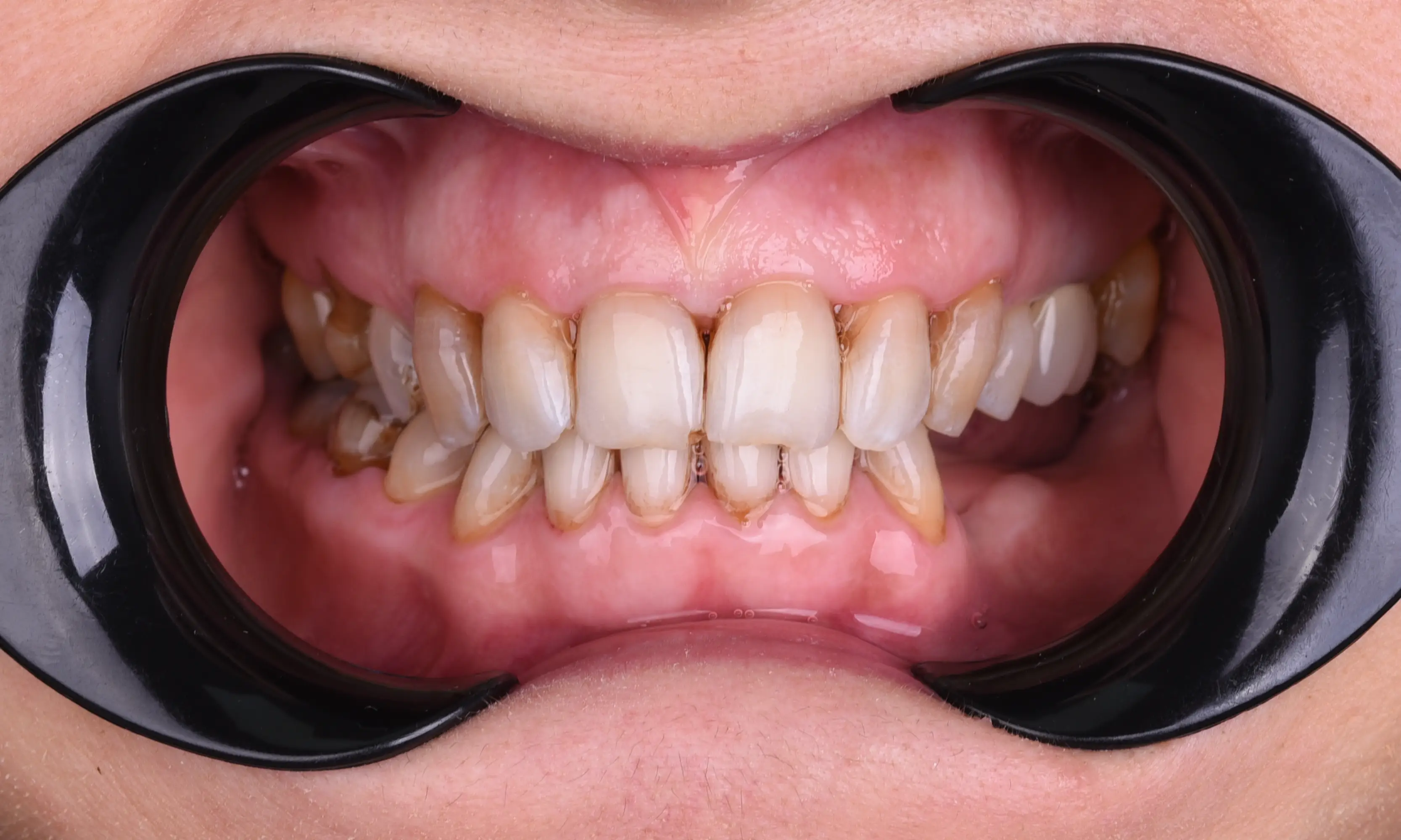 Tam Zirkonyum Öncesi - Vaka 26 - Milim Dental Hospital Bursa