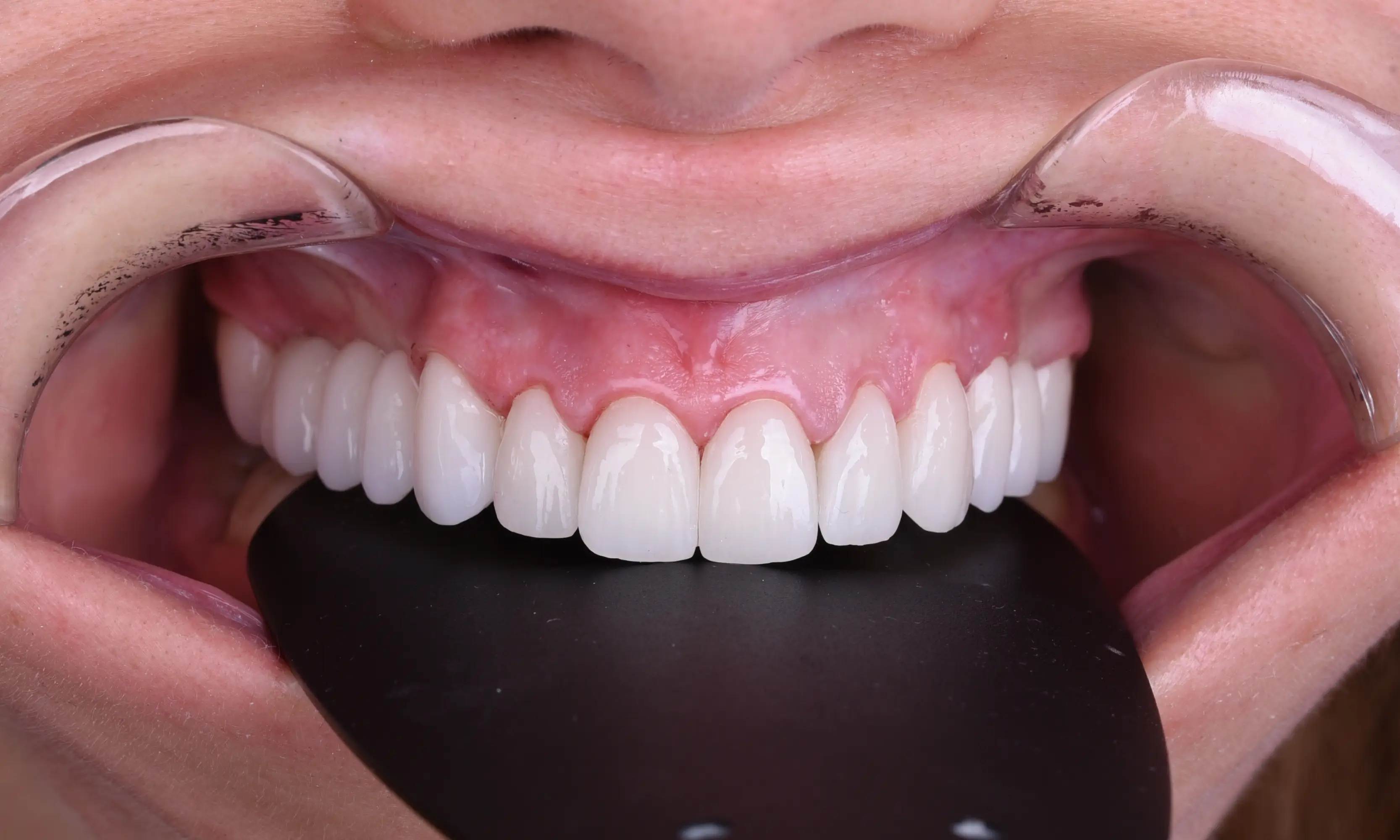 Full Veneers Sonrası - Vaka 33 - Milim Dental Hospital Bursa