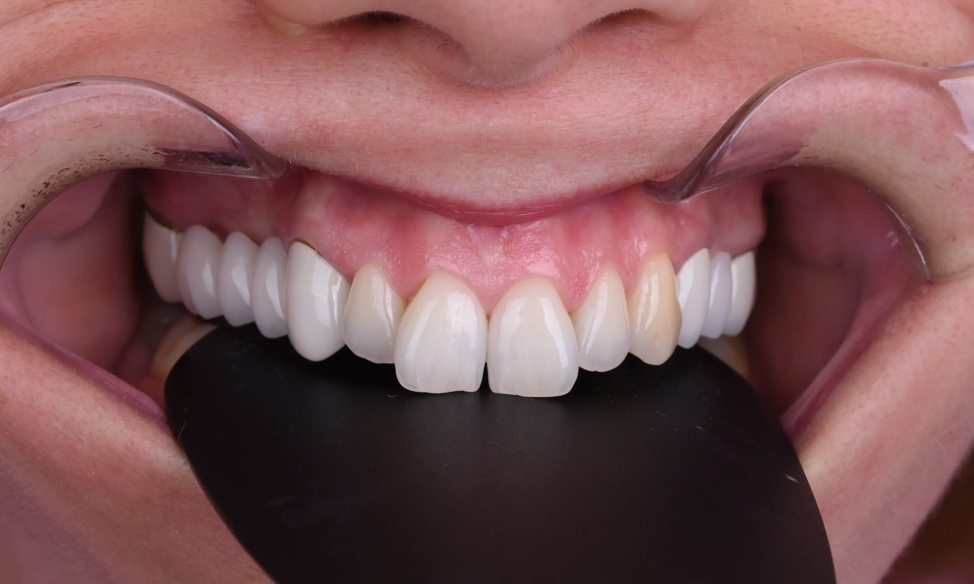 Full Veneers Öncesi - Vaka 33 - Milim Dental Hospital Bursa