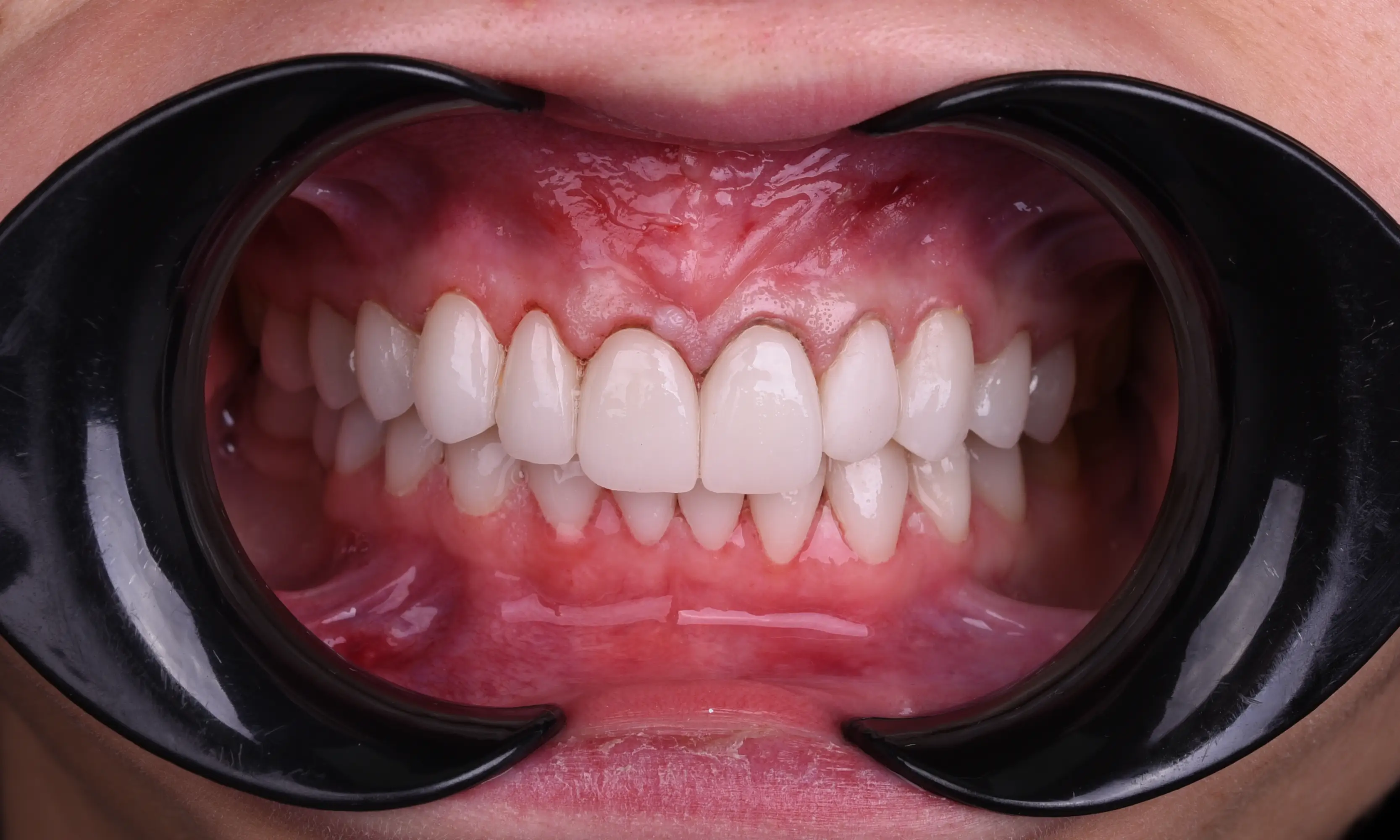 Full Veneers Sonrası - Vaka 37 - Milim Dental Hospital Bursa