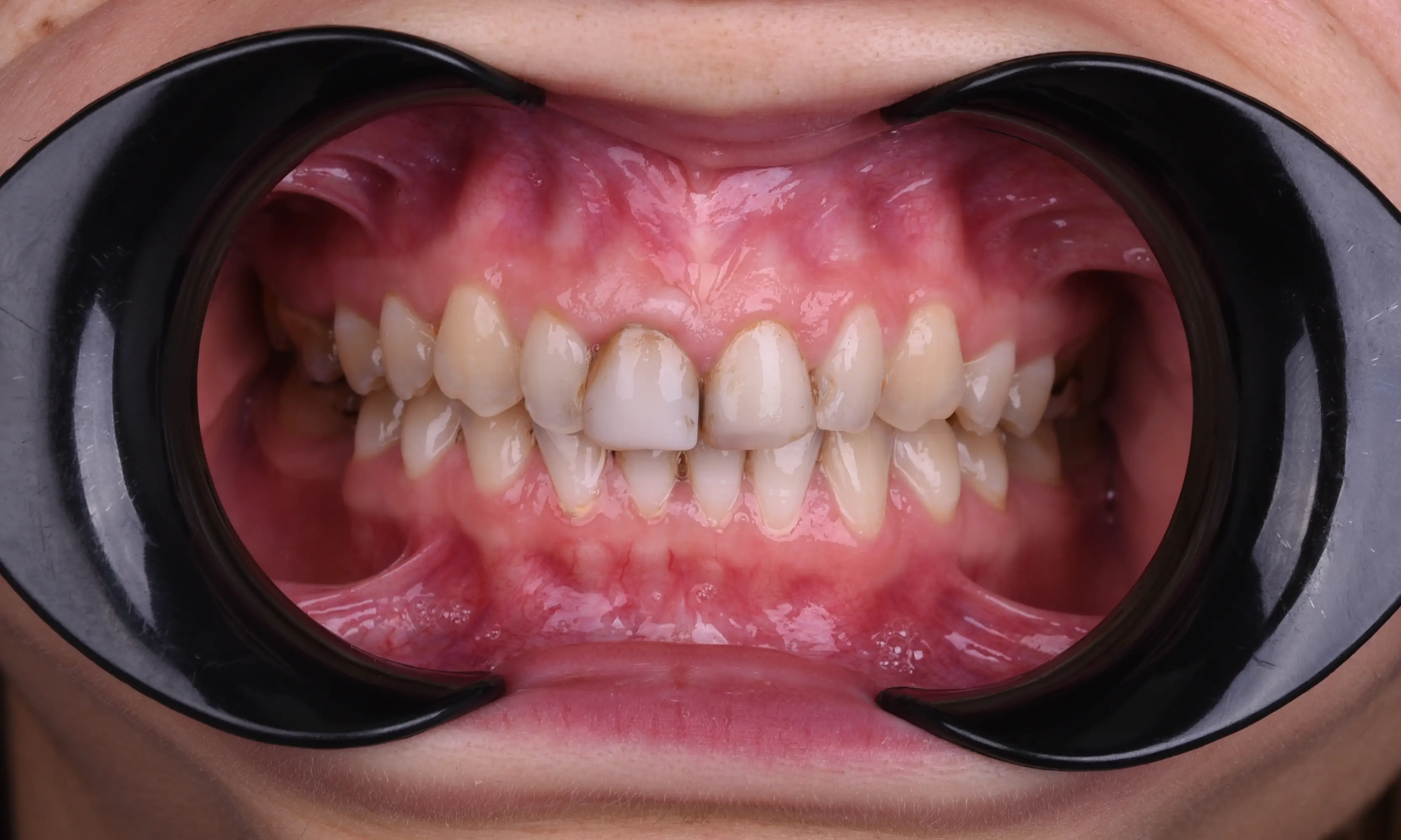 Full Veneers Öncesi - Vaka 37 - Milim Dental Hospital Bursa