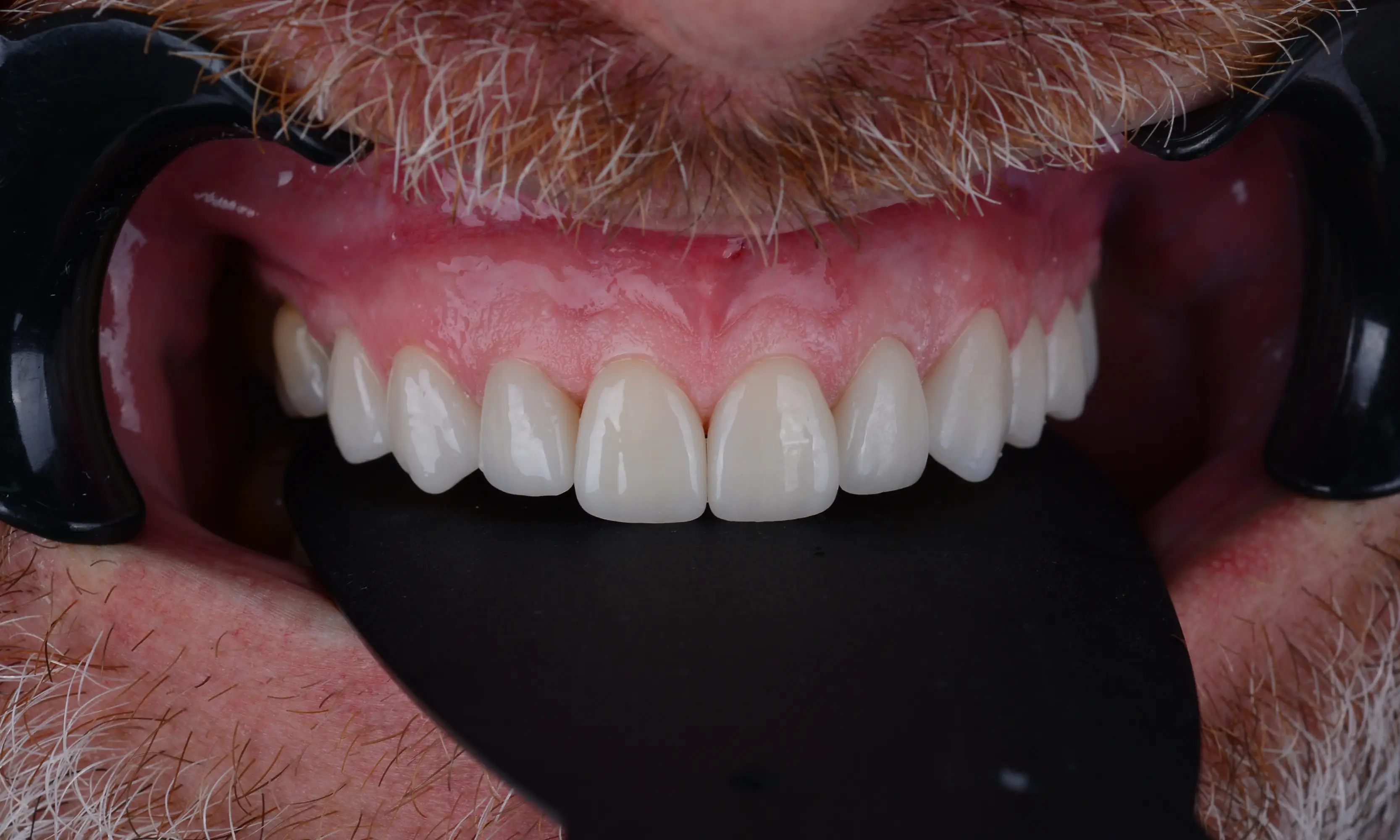Full Veneers Sonrası - Vaka 38 - Milim Dental Hospital Bursa