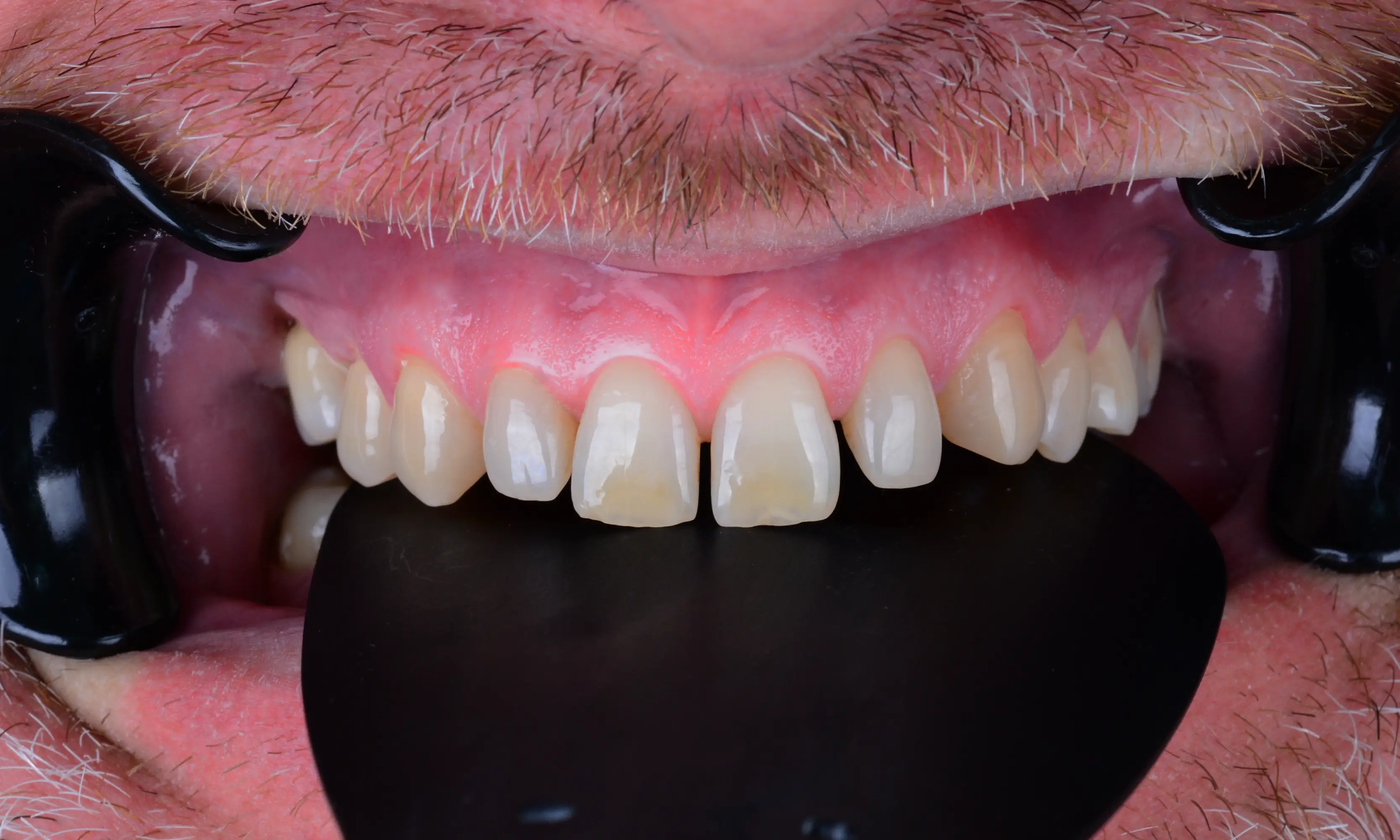 Full Veneers Öncesi - Vaka 38 - Milim Dental Hospital Bursa